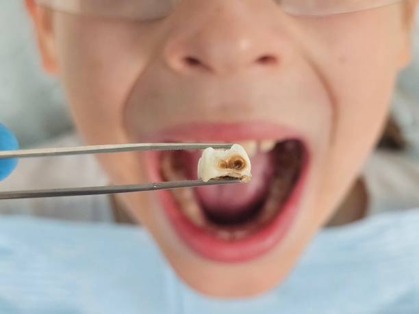 Best Emergency Dental Care for Abscessed Tooth in Holly Springs, NC
