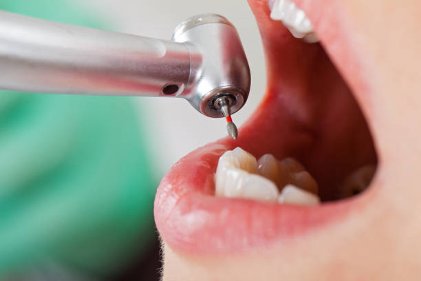Best Emergency Dentist for Lost Fillings or Crowns in Holly Springs, NC